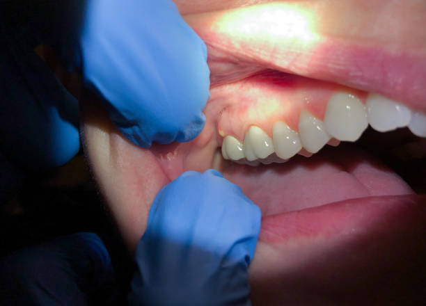 Best Emergency Tooth Extraction in Cullowhee, NC